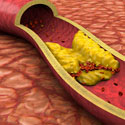 Cholesterole LDL